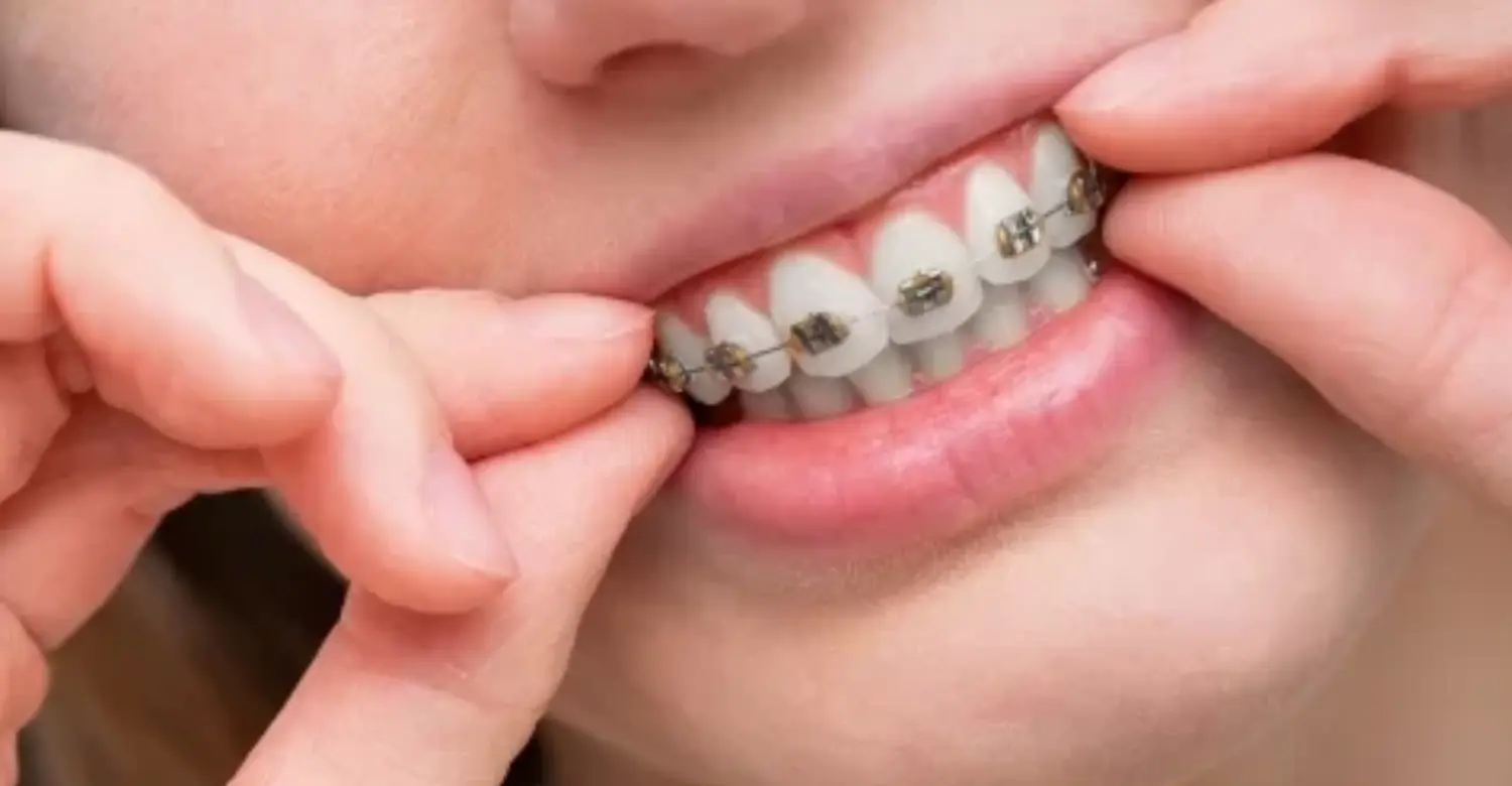 Can You Get Braces with Periodontal Disease 2